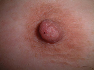 http://breastspecialist.co.uk/wp-content/uploads/2017/12/nipple-discharge.jpg