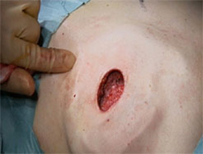Nipple Discharge - The Breast Specialist, Kefah Mokbel, London